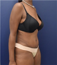 Liposuction After Photo by Richard Reish, MD, FACS; New York, NY - Case 35290