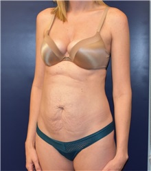 Liposuction Before Photo by Richard Reish, MD, FACS; New York, NY - Case 35293