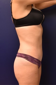 Liposuction After Photo by Richard Reish, MD, FACS; New York, NY - Case 35293