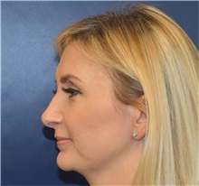Ear Surgery Before Photo by Richard Reish, MD, FACS; New York, NY - Case 35330