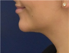 Chin Augmentation After Photo by Richard Reish, MD, FACS; New York, NY - Case 35333