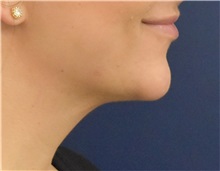 Chin Augmentation After Photo by Richard Reish, MD, FACS; New York, NY - Case 35333