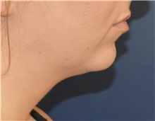 Chin Augmentation Before Photo by Richard Reish, MD, FACS; New York, NY - Case 35333