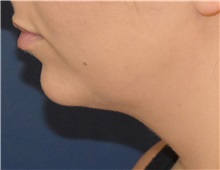Liposuction Before Photo by Richard Reish, MD, FACS; New York, NY - Case 35334