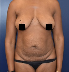 Liposuction Before Photo by Richard Reish, MD, FACS; New York, NY - Case 35338
