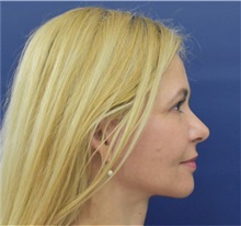 Facelift After Photo by Richard Reish, MD, FACS; New York, NY - Case 35379