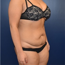 Liposuction Before Photo by Richard Reish, MD, FACS; New York, NY - Case 35381