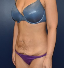 Tummy Tuck Before Photo by Richard Reish, MD, FACS; New York, NY - Case 36235