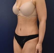 Liposuction After Photo by Richard Reish, MD, FACS; New York, NY - Case 36236