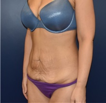 Liposuction Before Photo by Richard Reish, MD, FACS; New York, NY - Case 36236