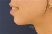 Chin Augmentation After Photo by Richard Reish, MD, FACS; New York, NY - Case 36258