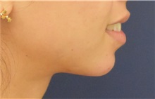 Chin Augmentation After Photo by Richard Reish, MD, FACS; New York, NY - Case 36258