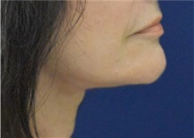 Facelift After Photo by Richard Reish, MD, FACS; New York, NY - Case 38257