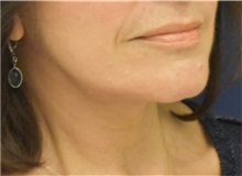Neck Lift After Photo by Richard Reish, MD, FACS; New York, NY - Case 38258