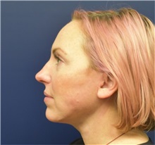 Facelift After Photo by Richard Reish, MD, FACS; New York, NY - Case 38324