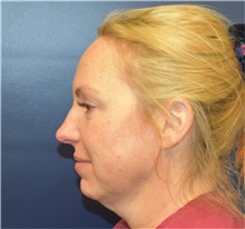 Neck Lift Before Photo by Richard Reish, MD, FACS; New York, NY - Case 38326