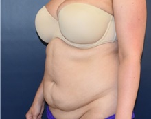 Tummy Tuck Before Photo by Richard Reish, MD, FACS; New York, NY - Case 40741