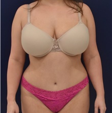 Liposuction After Photo by Richard Reish, MD, FACS; New York, NY - Case 40742