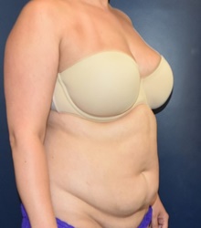 Liposuction Before Photo by Richard Reish, MD, FACS; New York, NY - Case 40742
