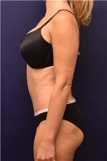 Liposuction After Photo by Richard Reish, MD, FACS; New York, NY - Case 43447