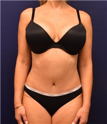 Liposuction After Photo by Richard Reish, MD, FACS; New York, NY - Case 43447