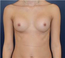 Breast Augmentation After Photo by Richard Reish, MD, FACS; New York, NY - Case 43551