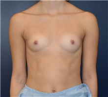 Breast Augmentation Before Photo by Richard Reish, MD, FACS; New York, NY - Case 43551