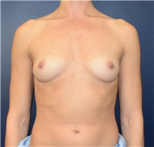 Breast Augmentation Before Photo by Richard Reish, MD, FACS; New York, NY - Case 43552