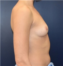 Breast Augmentation Before Photo by Richard Reish, MD, FACS; New York, NY - Case 43552