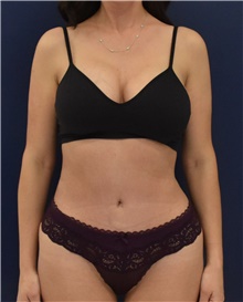 Liposuction After Photo by Richard Reish, MD, FACS; New York, NY - Case 43554