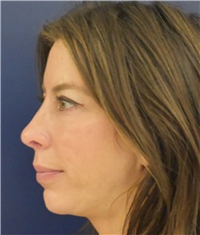 Chin Augmentation After Photo by Richard Reish, MD, FACS; New York, NY - Case 45327