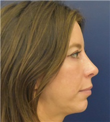 Chin Augmentation After Photo by Richard Reish, MD, FACS; New York, NY - Case 45327