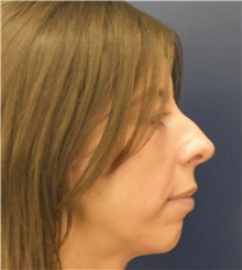 Chin Augmentation Before Photo by Richard Reish, MD, FACS; New York, NY - Case 45327