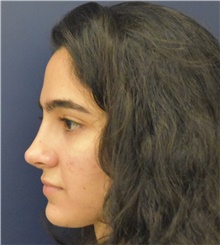 Rhinoplasty After Photo by Richard Reish, MD, FACS; New York, NY - Case 45357