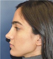 Rhinoplasty Before Photo by Richard Reish, MD, FACS; New York, NY - Case 45357