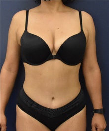 Tummy Tuck After Photo by Richard Reish, MD, FACS; New York, NY - Case 45360