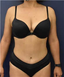 Liposuction After Photo by Richard Reish, MD, FACS; New York, NY - Case 45361