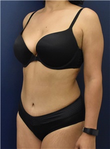 Liposuction After Photo by Richard Reish, MD, FACS; New York, NY - Case 45361