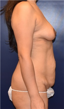 Liposuction Before Photo by Richard Reish, MD, FACS; New York, NY - Case 45361