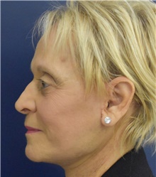 Facelift After Photo by Richard Reish, MD, FACS; New York, NY - Case 45362