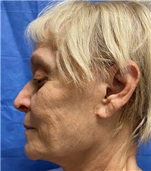 Facelift Before Photo by Richard Reish, MD, FACS; New York, NY - Case 45362