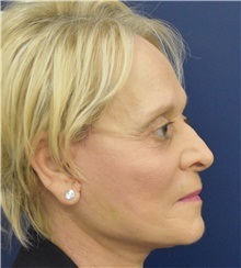 Facelift After Photo by Richard Reish, MD, FACS; New York, NY - Case 45362