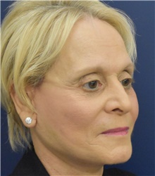 Facelift After Photo by Richard Reish, MD, FACS; New York, NY - Case 45362
