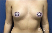Breast Augmentation Before Photo by Natalie Driessen, MD; Palm Desert, CA - Case 33028