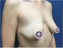 Breast Augmentation Before Photo by Natalie Driessen, MD; Palm Desert, CA - Case 33666