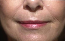 Dermal Fillers After Photo by Richard Sadove, MD; Gainesville, FL - Case 21972