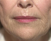 Dermal Fillers Before Photo by Richard Sadove, MD; Gainesville, FL - Case 21972