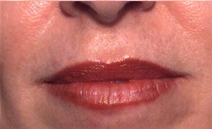 Dermal Fillers After Photo by Richard Sadove, MD; ,  - Case 21978