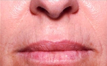 Dermal Fillers Before Photo by Richard Sadove, MD; ,  - Case 21978