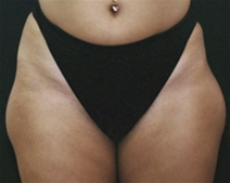 Liposuction Before Photo by Richard Sadove, MD; Gainesville, FL - Case 22051